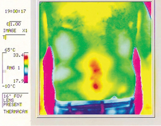 Back thermography after 20 minutes with Back Wrap