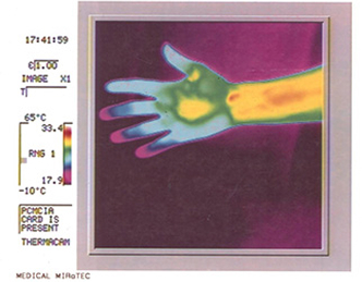 Hand thermography before using Mirotec